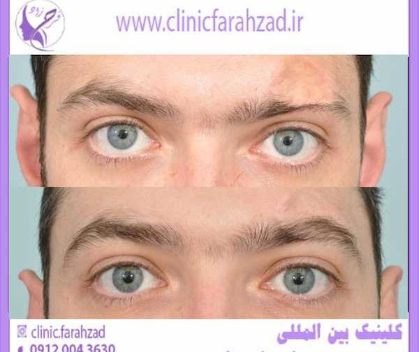 عکس کاشت ابرو مردانه