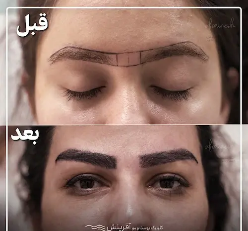 عکس کاشت ابرو مردانه