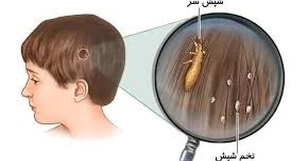 عکس شپش وتخم شپش