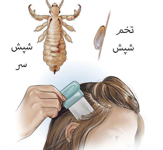 عکس شپش تخم گذار