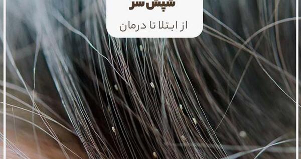 عکس شپش واقعی در مو