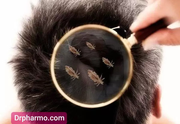 عکس شپش واقعی در مو