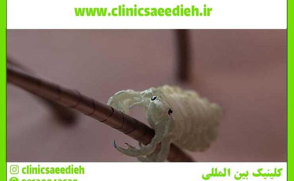 عکس واقعی شپش سر