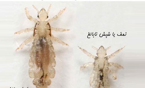 عکس تخم شپش واقعی