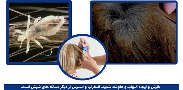عکس رشک شپش سر