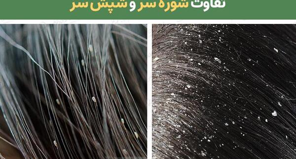 عکس شپش در موی کودکان