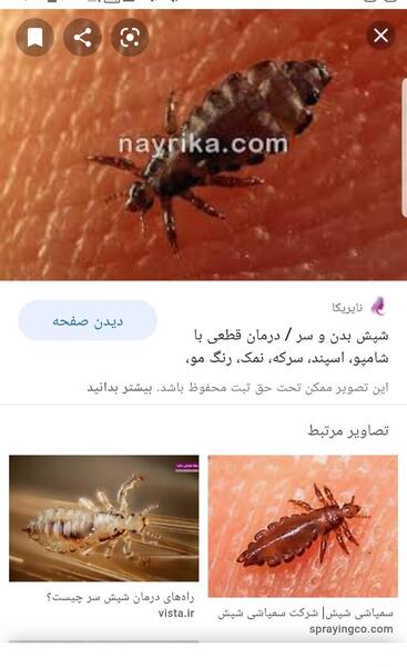 عکس شپش در موی کودکان
