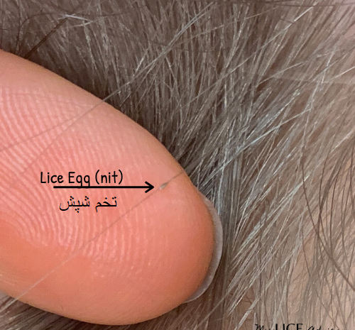 عکس تخم شپش روی مو