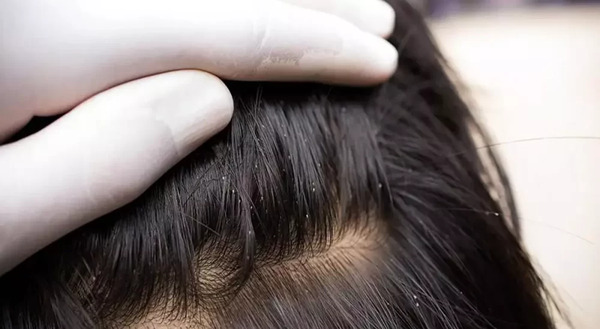 عکس شپش خیلی ترسناک