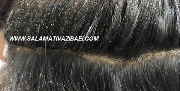 عکس شپش مو از نزدیک