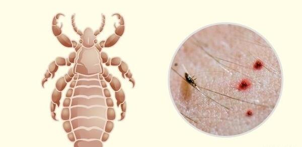 عکس نیش شپش بدن