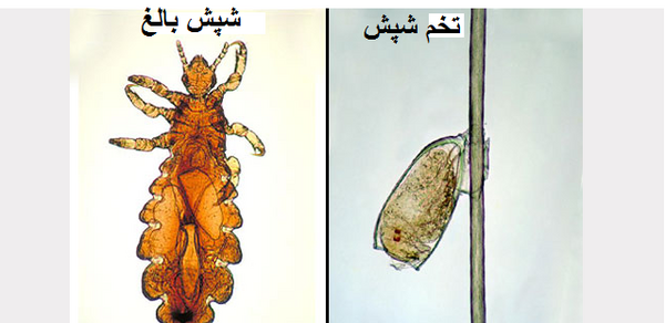 عکس تخم شپش سر کودک