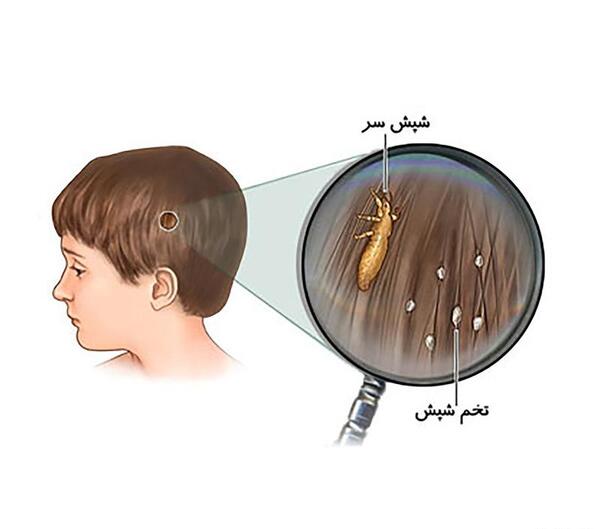عکس تخم شپش سر کودک