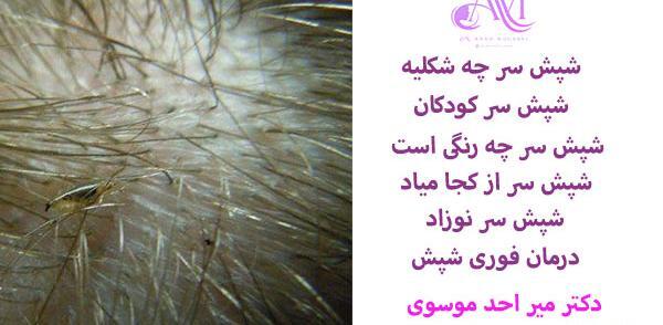 عکس واقعی از شپش سر