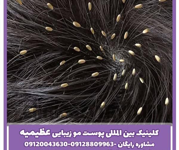 عکس عكس شپش سر