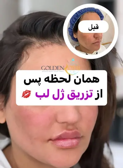 عکس ژل لب طبیعی