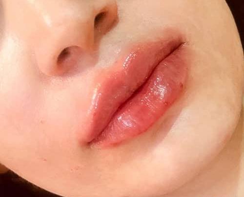عکس ژل لب طبیعی