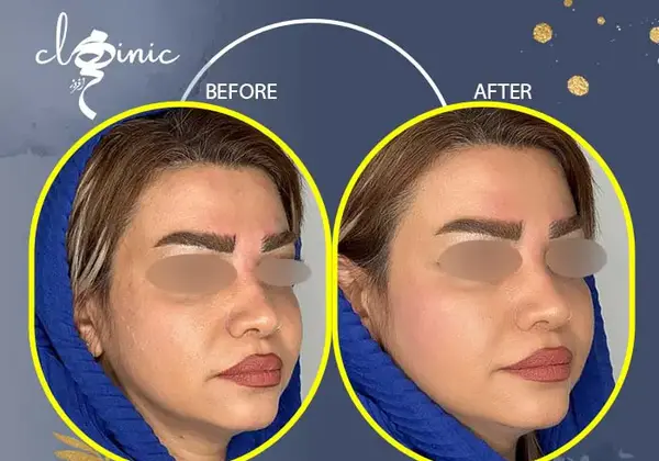 عکس ژل گونه طبیعی