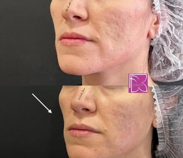 عکس ژل گونه طبیعی