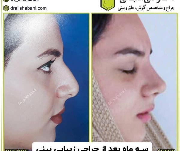 عکس بینی نیمه فانتزی طبیعی