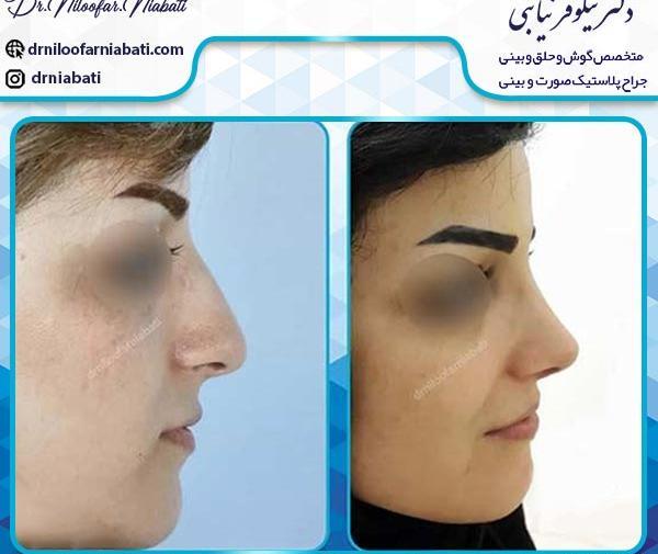 عکس بینی نیمه فانتزی طبیعی