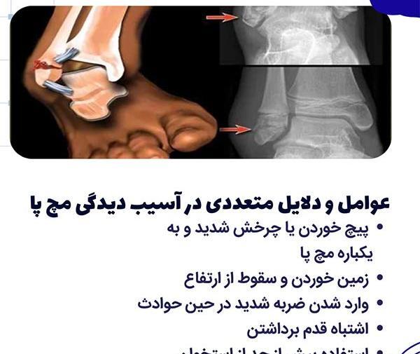 عکس قوزک پای شکسته