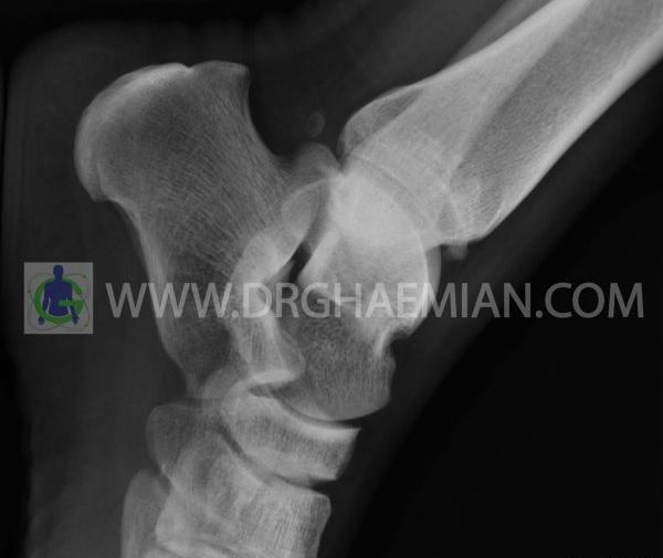 عکس قوزک پای شکسته