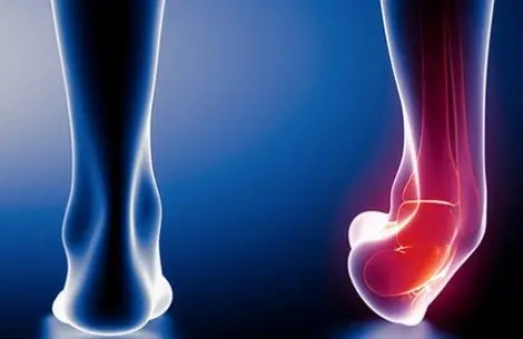 عکس قوزک پای شکسته