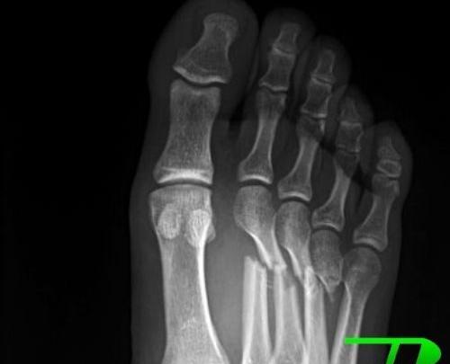 عکس قوزک پای شکسته
