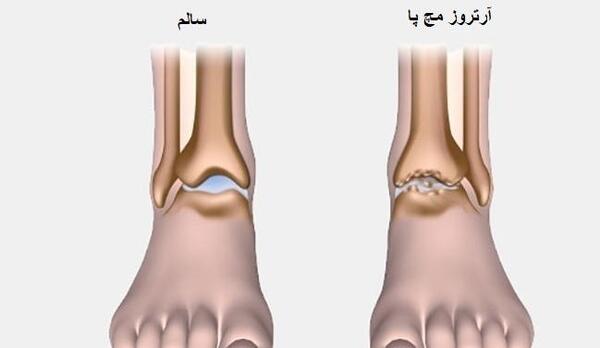 عکس رادیولوژی قوزک پای سالم