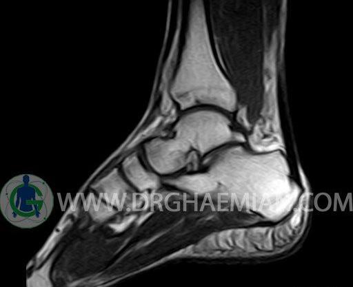 عکس رادیولوژی قوزک پای سالم