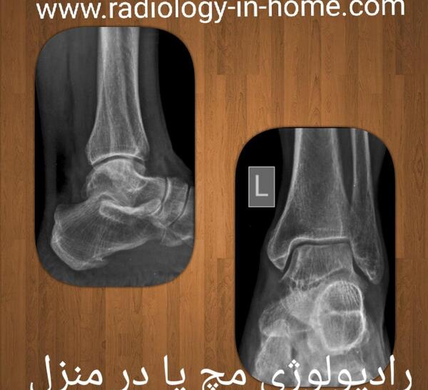 عکس رادیولوژی قوزک پای سالم