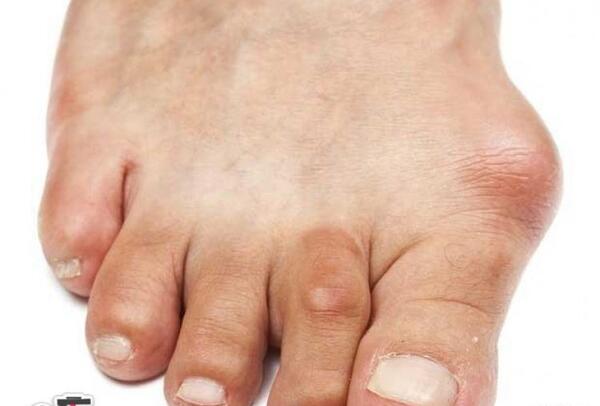 عکس قوزک پای