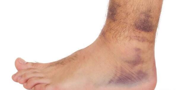 عکس قوزک پای