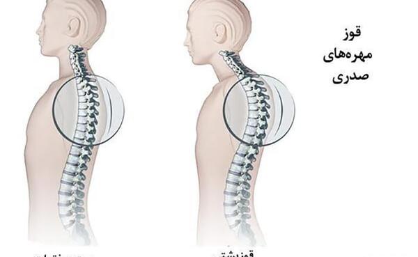 عکس از قوز کمر