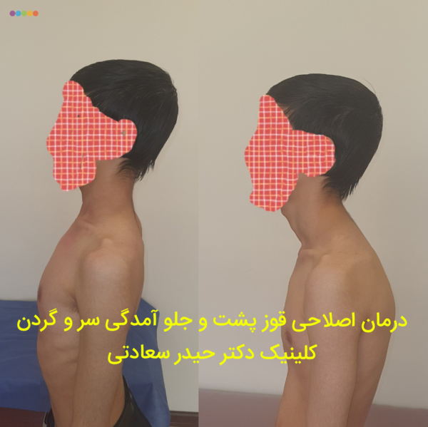 عکس از قوز کمر