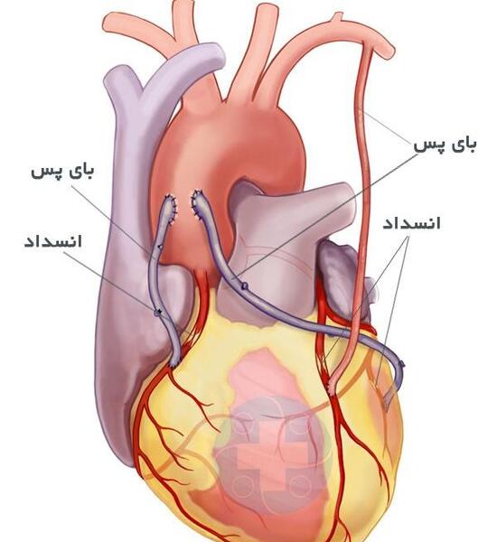 عکس رگ قلب گرفته