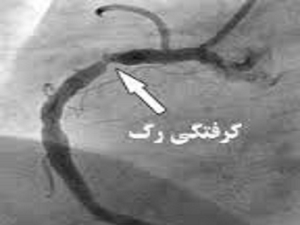 عکس رگ قلب گرفته