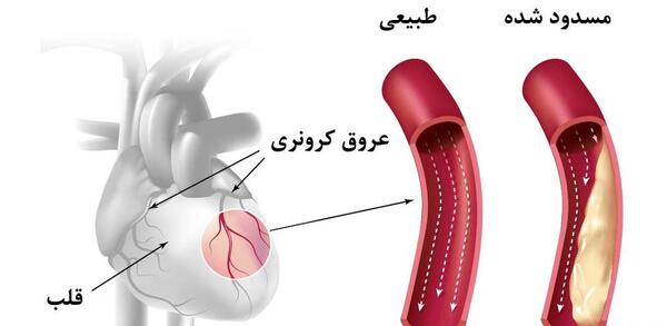 عکس رگ قلب گرفته