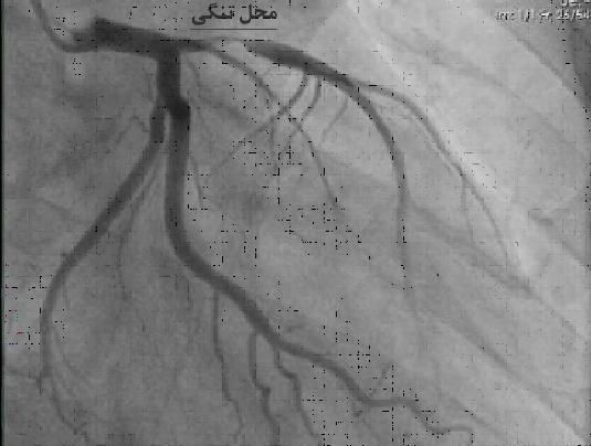 عکس رگ قلب گرفته