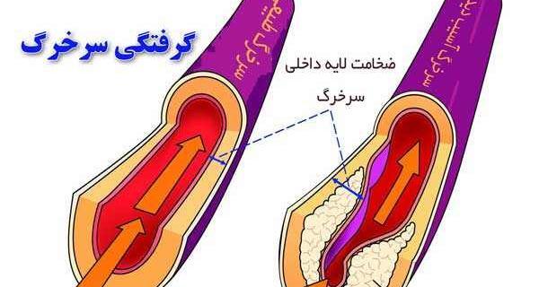 عکس رگ قلب گرفته