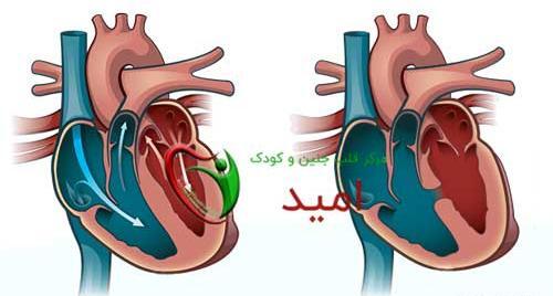 عکس قلب سوراخ نوزاد