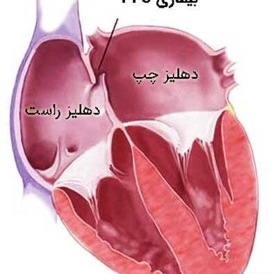 عکس قلب سوراخ نوزاد