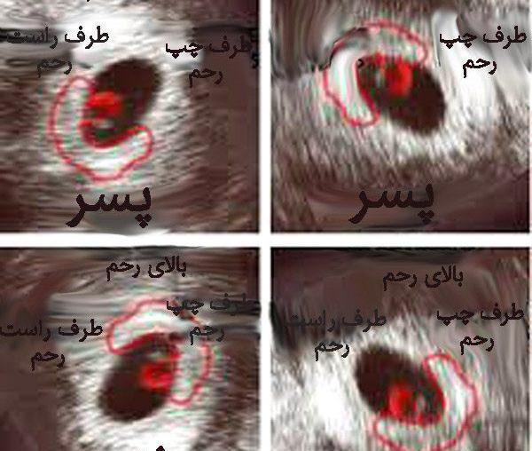 عکس قلب بچه نوزاد