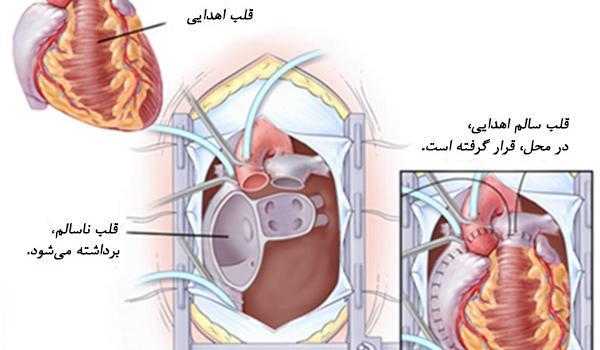 عکس عمل قلب باز نوزاد