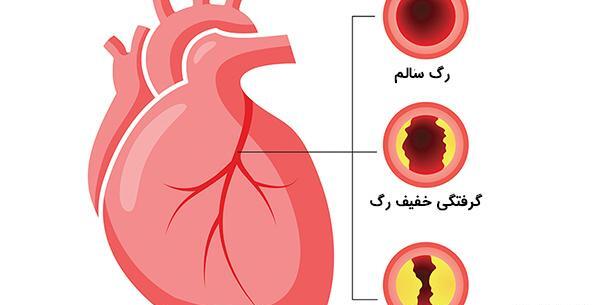 عکس رگهای گرفته قلب