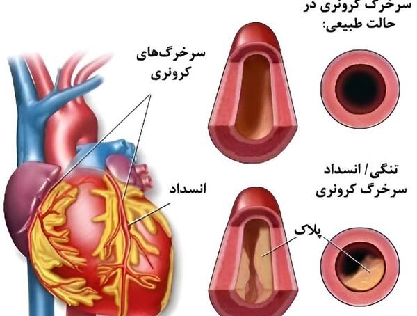 عکس رگهای گرفته قلب