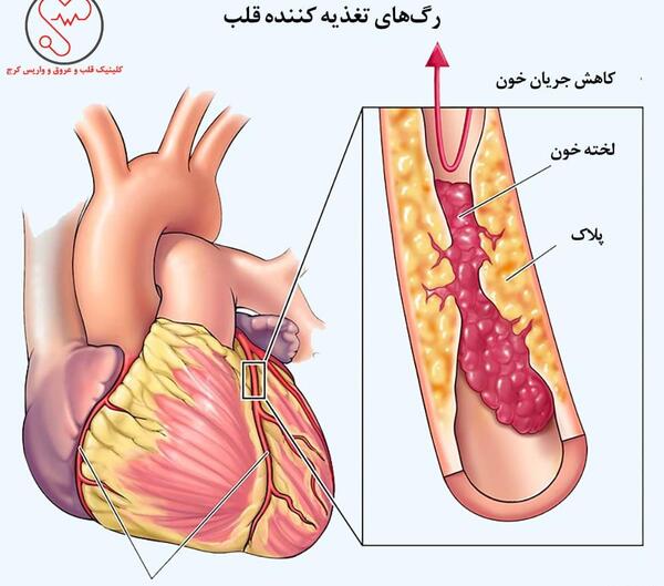 عکس رگهای گرفته قلب