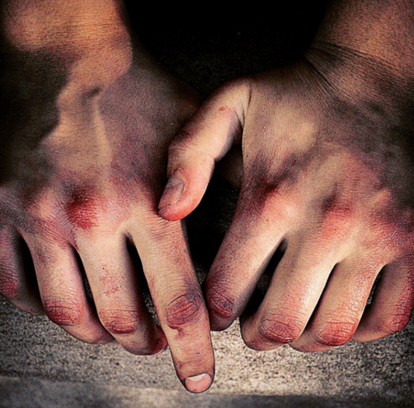 عکس دست مرد زخمی
