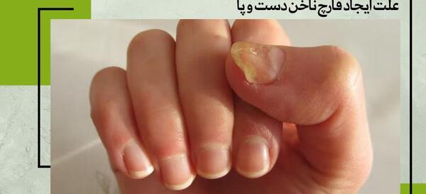 عکس قارچ گرفتن ناخن